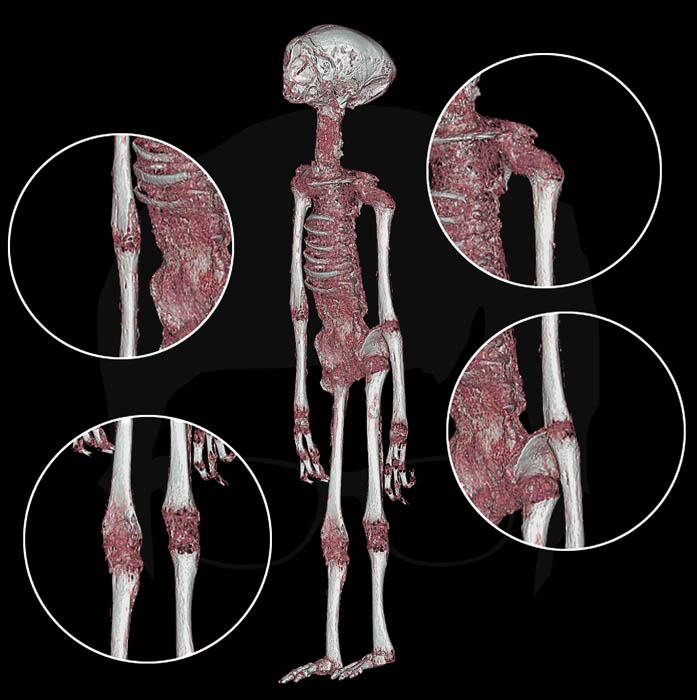 Huesos quebrados y astillados. Imagen 3D de la momia denominada Alberto, generada a partir de las tomografías que se realizaron a las «momias de Nasca», el 23 de enero del 2020 en Lima.